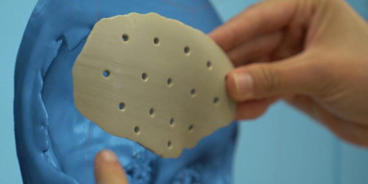 3D Printing Is Ready To Tackle Plastic Body Implants