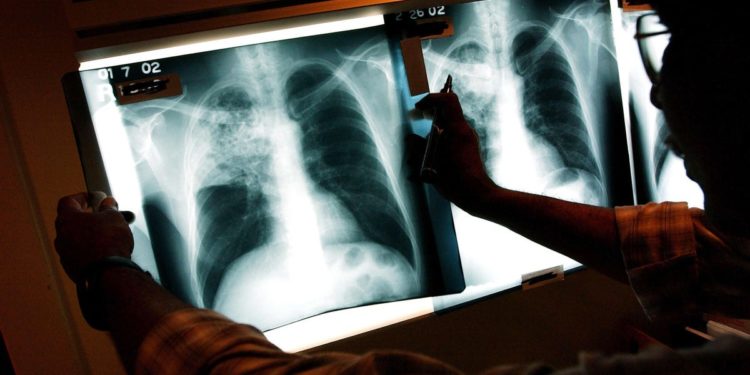 Could Tuberculosis Infection Provide Protection From Developing Covid?