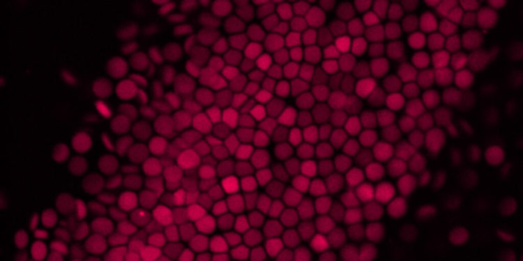 Multiple myeloma defies early detection. This precursor could help