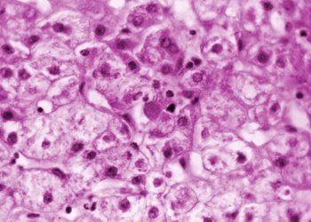 N.C. is second U.S. state to report unusual cases of hepatitis in kids