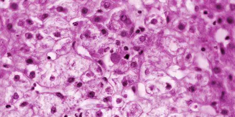 N.C. is second U.S. state to report unusual cases of hepatitis in kids