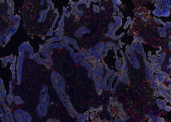 Trying a three-drug combo to help engineered T cells fight cancer
