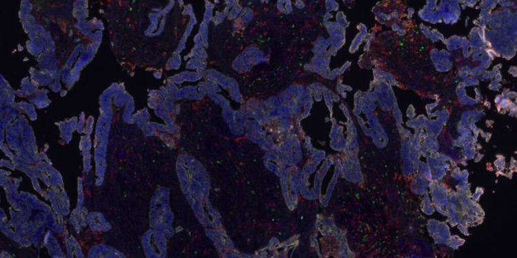 Trying a three-drug combo to help engineered T cells fight cancer