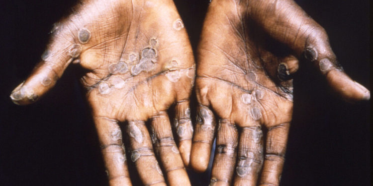 A CDC expert answers questions on monkeypox