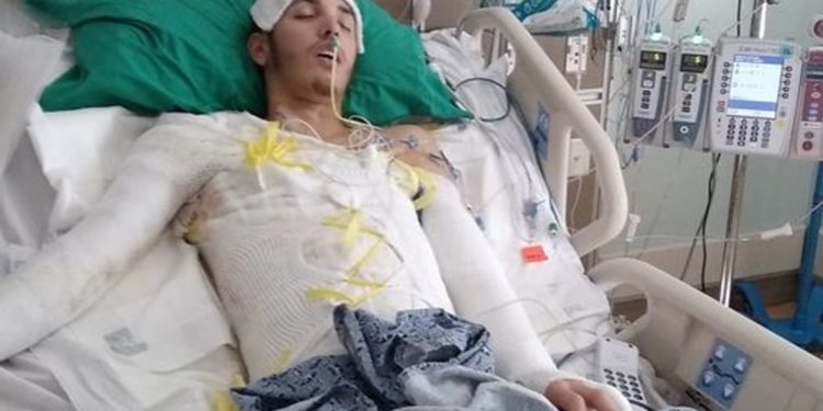 Florida Man With Burns To 75% Of Body After Taser Shock May Still Face Charges