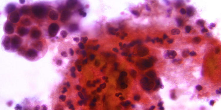 Study uncovers clues to rise in uterine cancer death rates