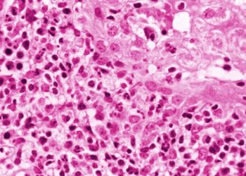 U.S. reports 180 cases of unexplained hepatitis in children