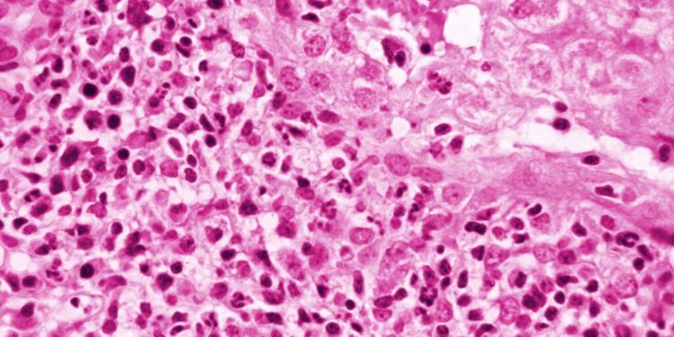 U.S. reports 180 cases of unexplained hepatitis in children