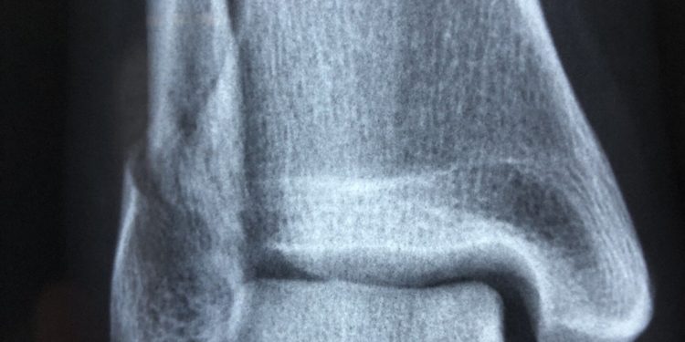 New study strengthens link between smoking and increased fracture risk in men