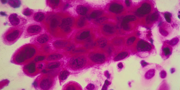 Despite overall decline, late-stage cervical cancer cases are rising